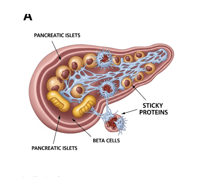 Sticky Proteins And Diabetes 2 sticky proteins